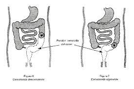 tumor-de-colon-y-recto-10