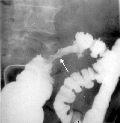 tumor-de-colon-y-recto-4