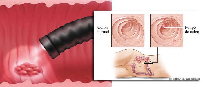 tumor-de-colon-y-recto-5