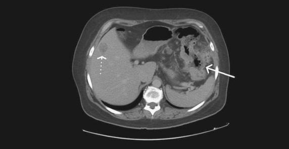 tumor-de-colon-y-recto-7