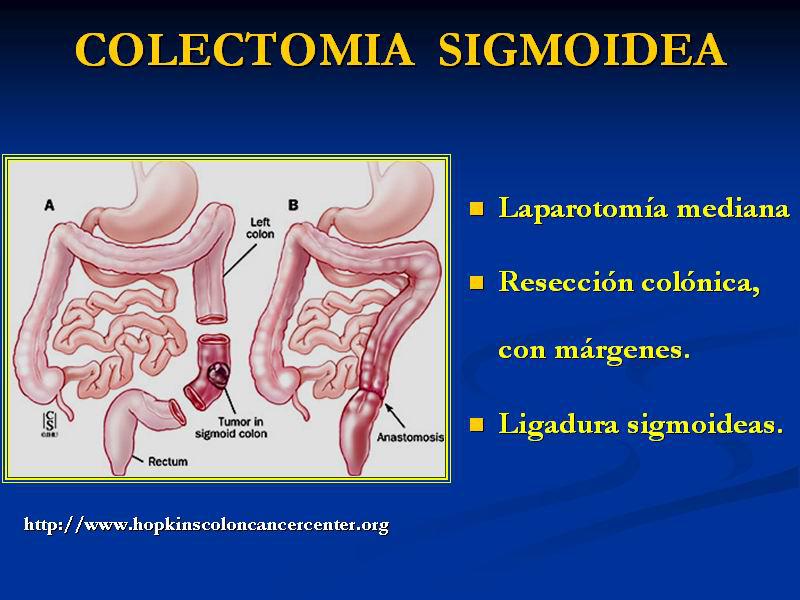 tumor-de-colon-y-recto-9