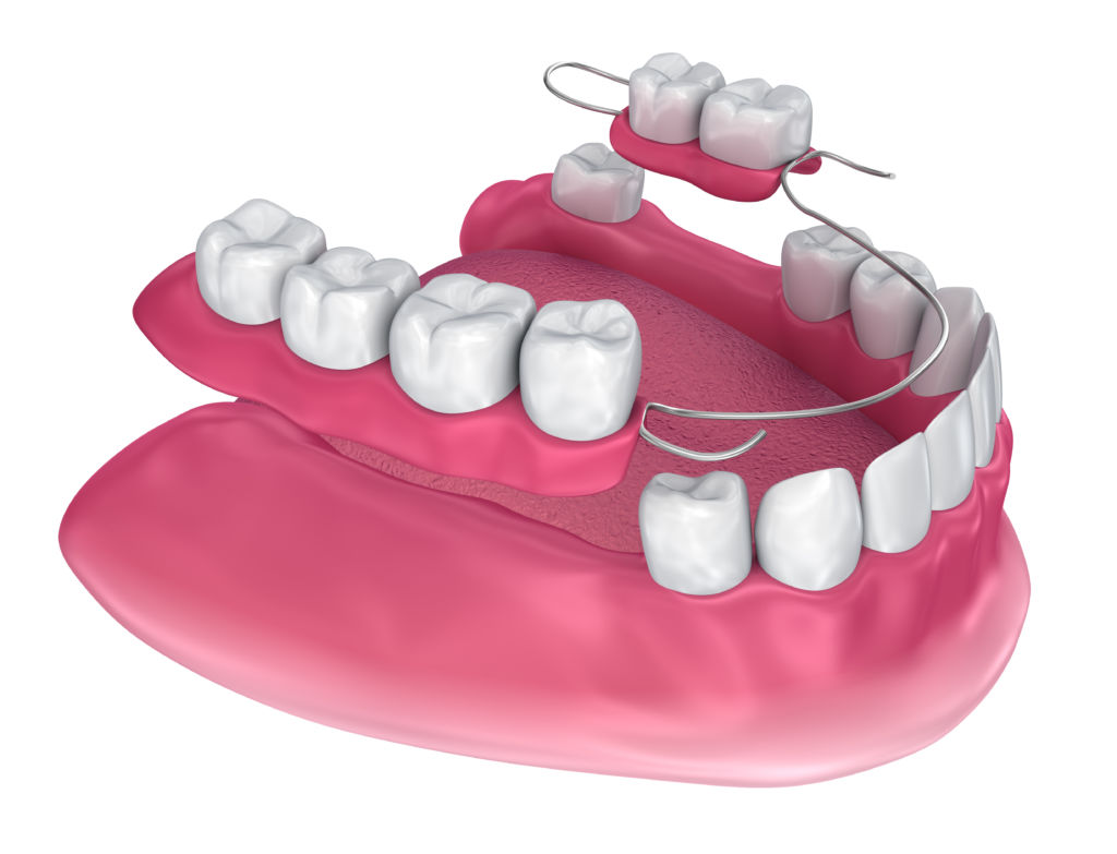 Removable Partial Denture