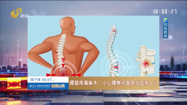 20240903ã€Šå¥åº·å±±ä¸œã€‹ï¼šè…°è…¿ç–¼ç—›éº»æœ¨ï¼å°å¿ƒè…°æ¤Žé—´ç›˜çªå‡ºç—‡æ‰¾ä¸Šé—¨