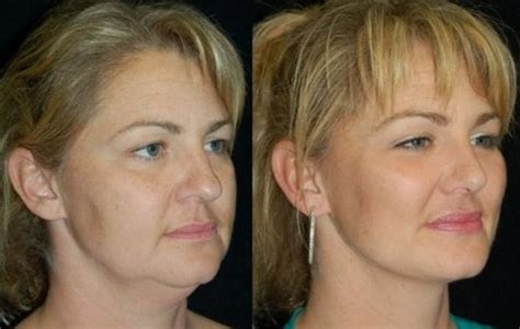 How To Get Rid Of Face Fat Surgery - change comin