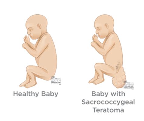 Sacrococcygeal Teratoma Tumor Surgery | Best Surgeon for Tumor in Udaipur