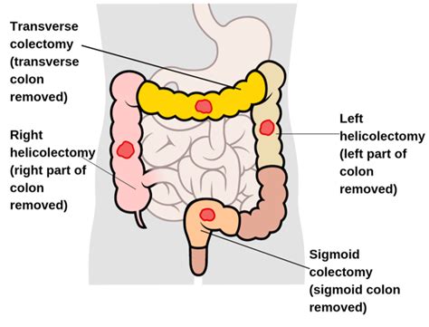 Types of surgery for colon and rectal cancer | Irish Cancer Society