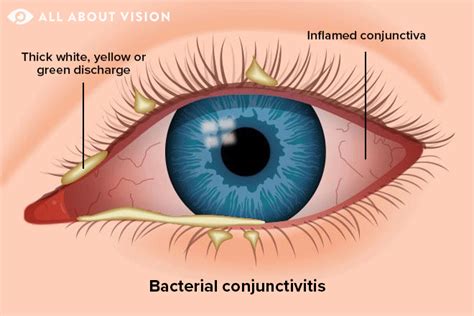 146 Images Viral Conjunctivitis For FREE - MyWeb