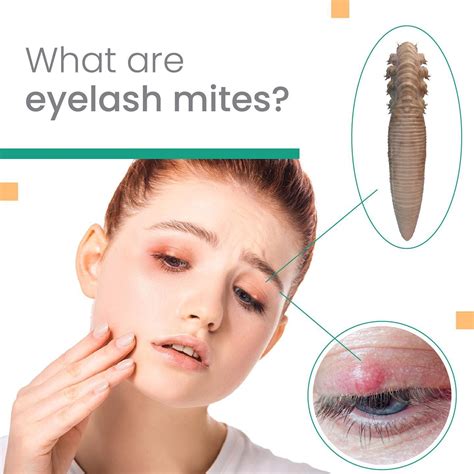 What are eyelash mites? . There are two types of Demodex mites called ...