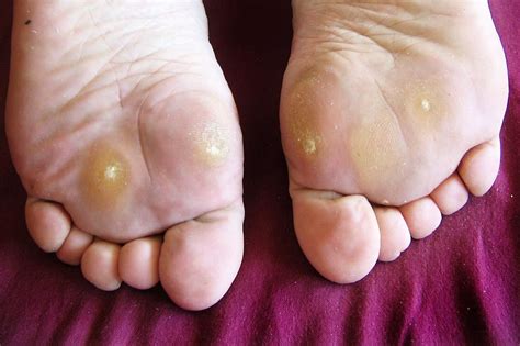 Can You Recognize Plantar Warts on Feet?