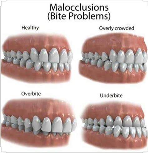 Perfect Bite Teeth Alignment