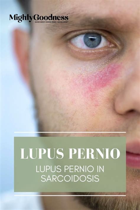 Lupus Pernio | Lupus Pernio in Sarcoidosis in 2022 | Lupus pernio ...