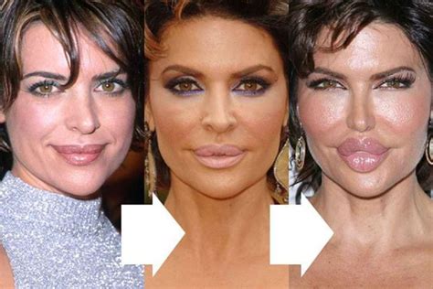 Lisa Rinna Facelift Lip Injection And Cheek Implan #LipGloss ...