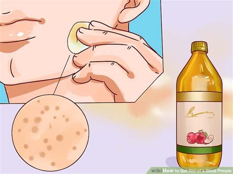 4 Ways to Get Rid of a Blind Pimple - wikiHow