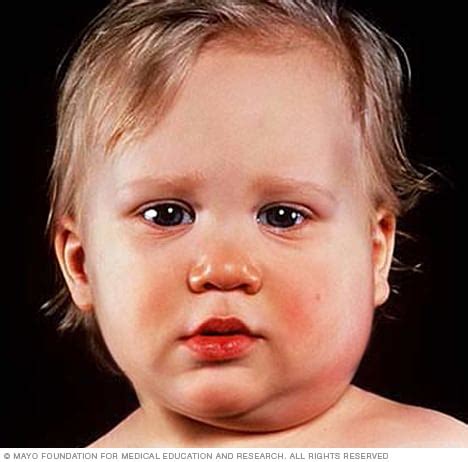 Mumps - Symptoms and causes (2023)