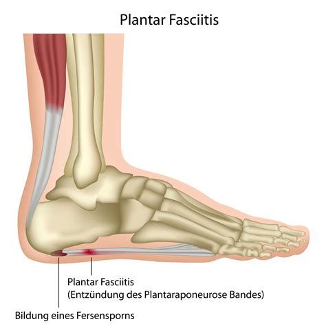 Plantar Faciitis Natural Remedies: Symptoms & Surgery for Plantar ...