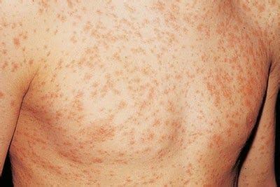 ONE OF HIV SYMPTOMS IS RASH. A VERY IMPORTANT ARTICLE TO READ | by ...