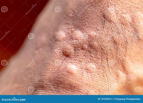 The Lesion on Foot after Caused by Ants Bites Red Imported Fire Ant ...