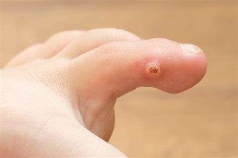 Warts on Your Feet? Symptoms & Causes of Plantar Warts - Foot and Ankle ...