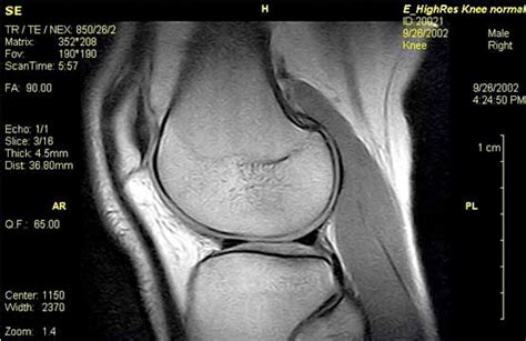 Ex-Scan UK MRI Scan Knees