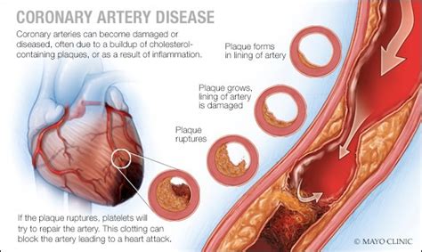 Coronary Artery Disease