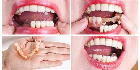 Dentures Before and After Stories That Will Amaze You!