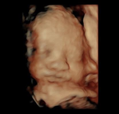 31 Week Ultrasound - Reveal 3D/4D Ultrasound Studio