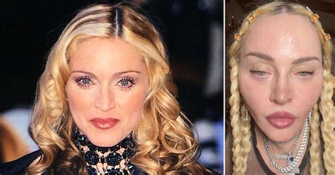 Madonna's Bizarre Face Transformation — Plastic Surgeons Weigh In