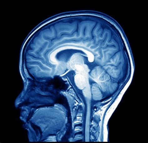 magnetic resonance image (MRI) of the brain - ODC