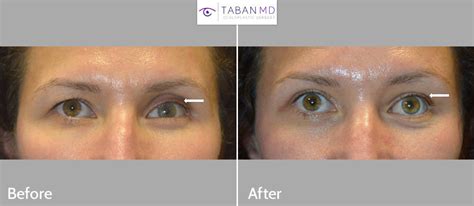 Prosthetic Eye & Socket Surgery Before and After Photos | Taban MD