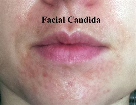 Candida of the skin: facial yeast and how it can occur - Lea Advanced ...