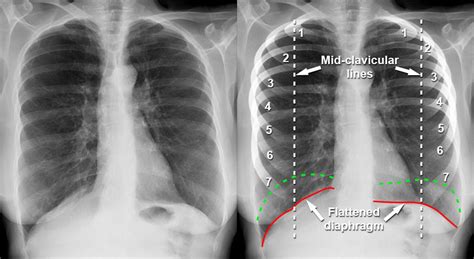 Chest X Ray Pneumonia Vs Bronchitis