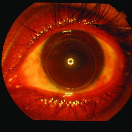 Corneal perforation and iris protrusion in the right eye. | Download ...