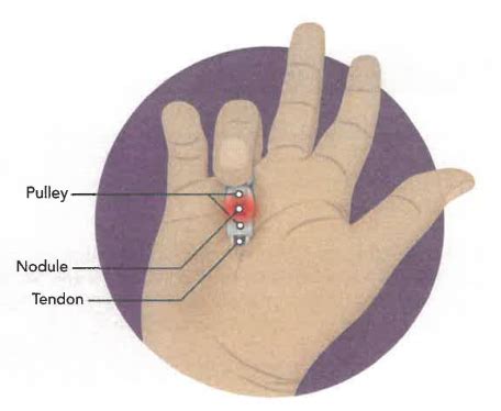 Trigger Finger - Winchester Radiologists