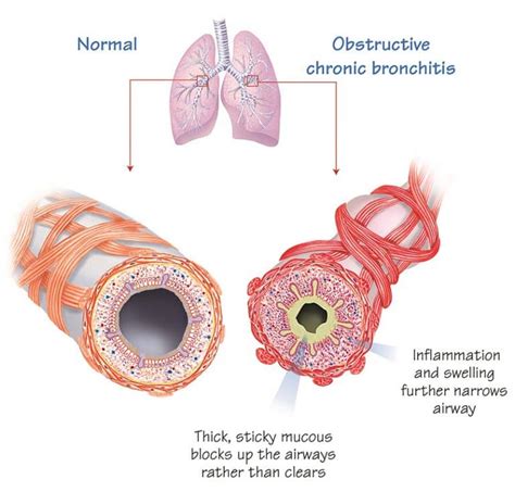 COPD | Resources - Chronic Obstructive Pulmonary Disease