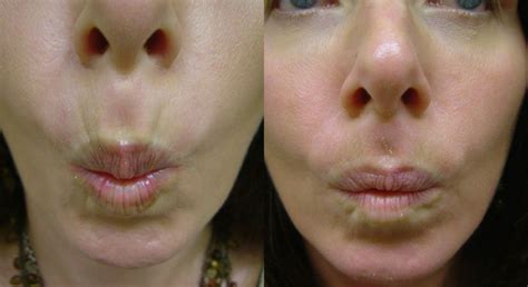 Botox Results | DM Cosmetic and Wellness