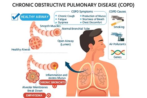 COPD: Symptoms, Causes, Risk, Diagnosis and Treatment