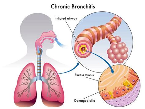 Bronchitis and Chronic Bronchitis - Condition and Treatment