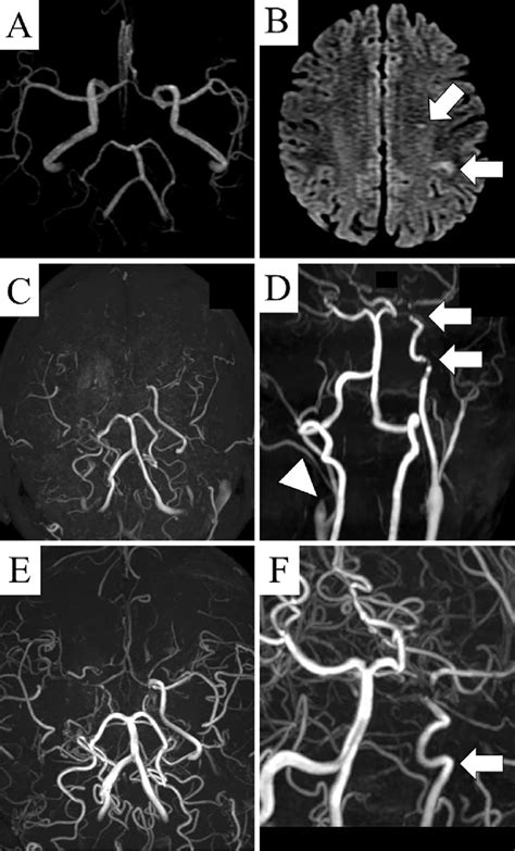 Figure.A: Brain magnetic resonance angiography (MRA) scans taken eight ...