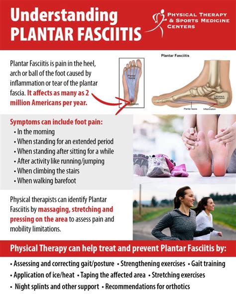 Plantar Fasciitis Treatment Guide | eduaspirant.com