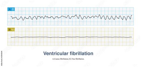 Fine Ventricular Fibrillation Vs Coarse Ventricular Fibrillation