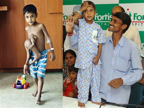 Parasitic twin dangling from Indian boy's stomach removed in Bangalore ...