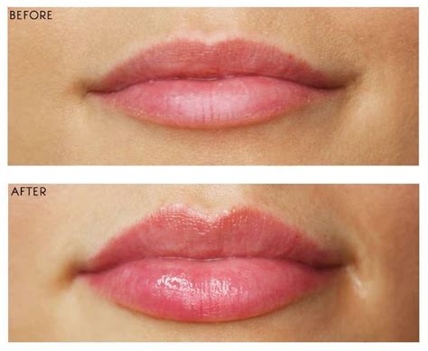 The Cupid’s Bow Lip Treatment | Aestha Clinic