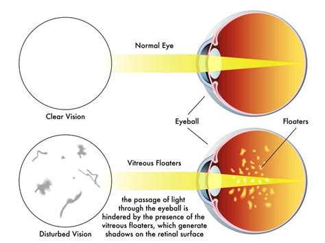 What Causes Eye Floaters? - Heffington's