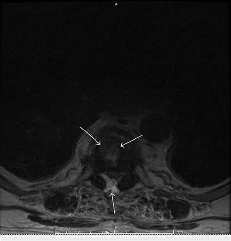 Transverse view of thoracic spine magnetic resonance imaging (MRI). MRI ...