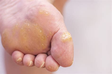 Warts on Your Feet? Symptoms & Causes of Plantar Warts - Foot and Ankle ...