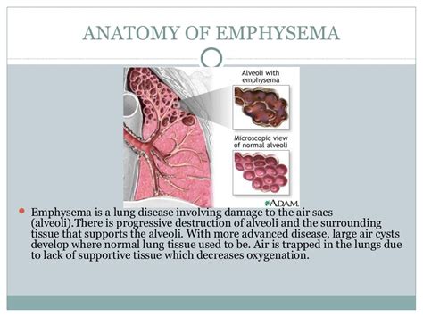 Emphysema