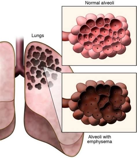 Emphysema: Causes, Symptoms, Diagnosis & Treatment » How To Relief