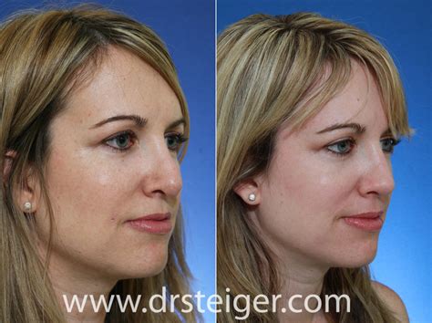 fix-bad-nose-job | Steiger Facial Plastic Surgery | Boca Raton Facelift ...