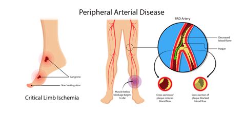 Peripheral Artery Disease