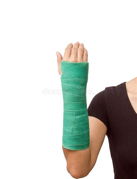 Broken Arm with Green Cast on White Background Stock Image - Image of ...